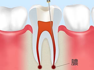 ふじもと歯科診療所の根管治療について